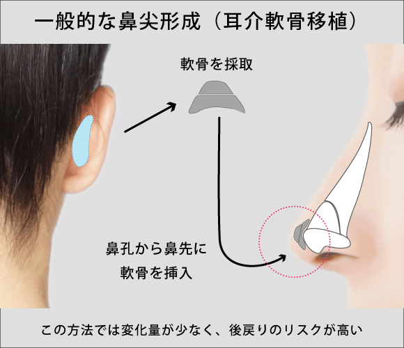 一般的な鼻尖形成（耳介軟骨移植）